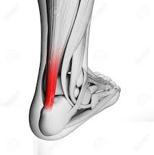 Achilles tendonitis treatment