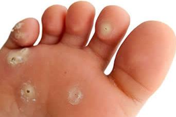 Corns and calluses treatment