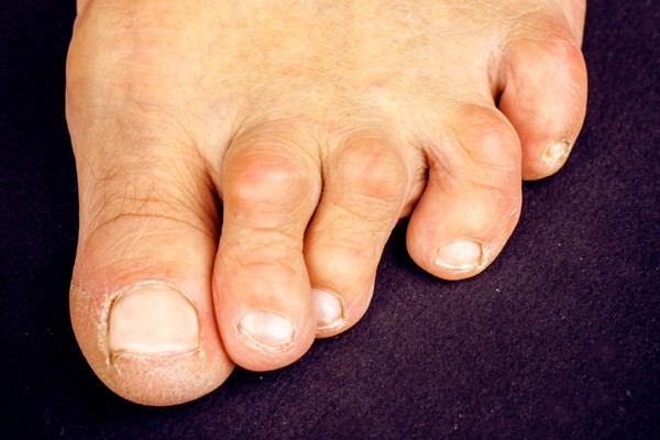 Hammertoes treatment